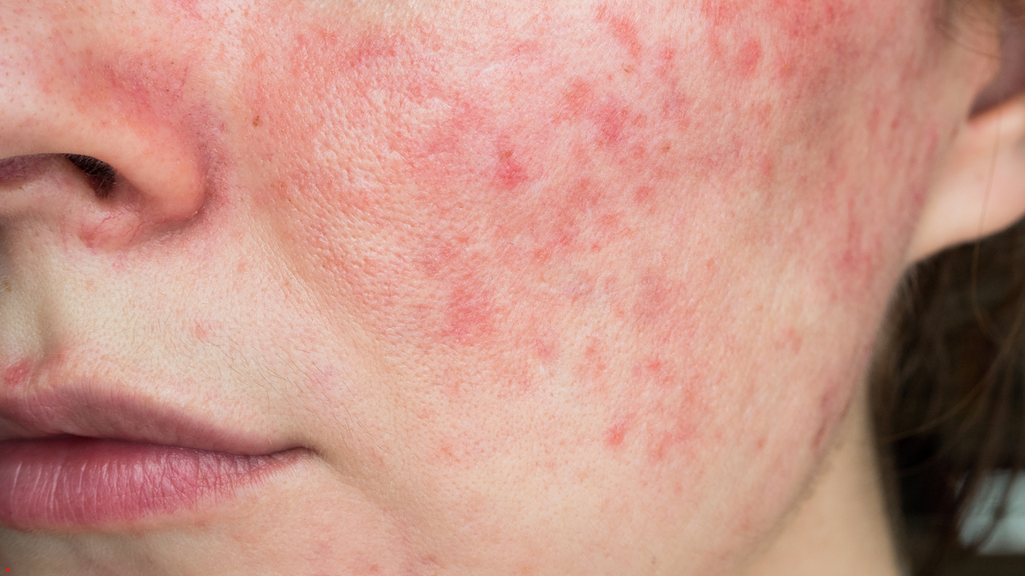 Wat is rosacea? Zo behandel je het!