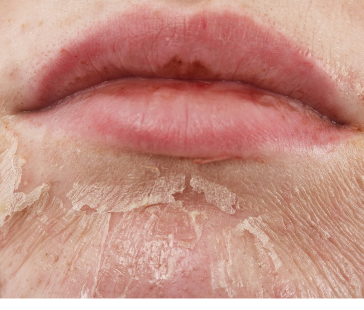 Voor welke huidproblemen is een chemische peeling geschikt?