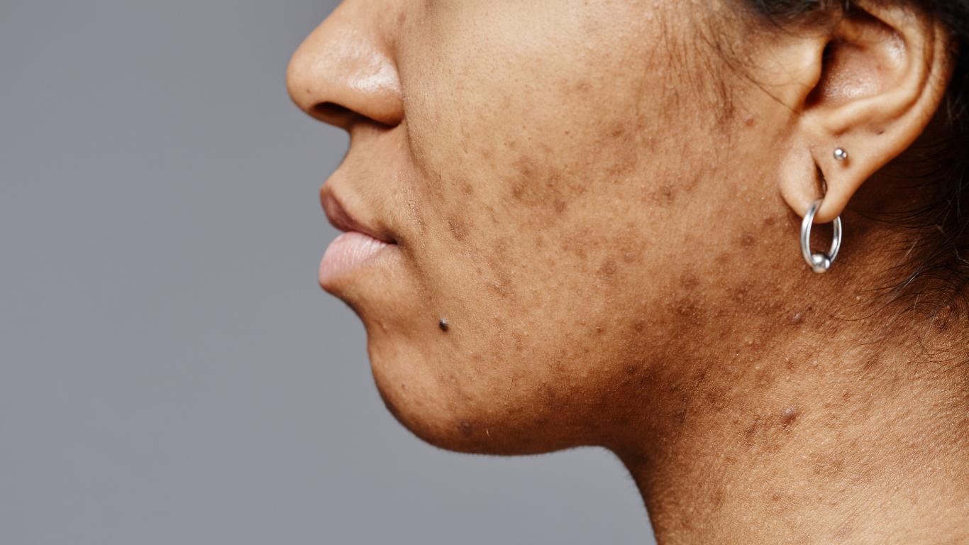 Wat is de oorzaak van hyperpigmentatie?