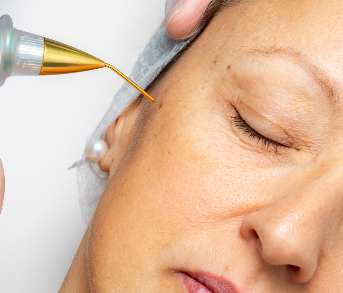 Wat is plasma lifting?