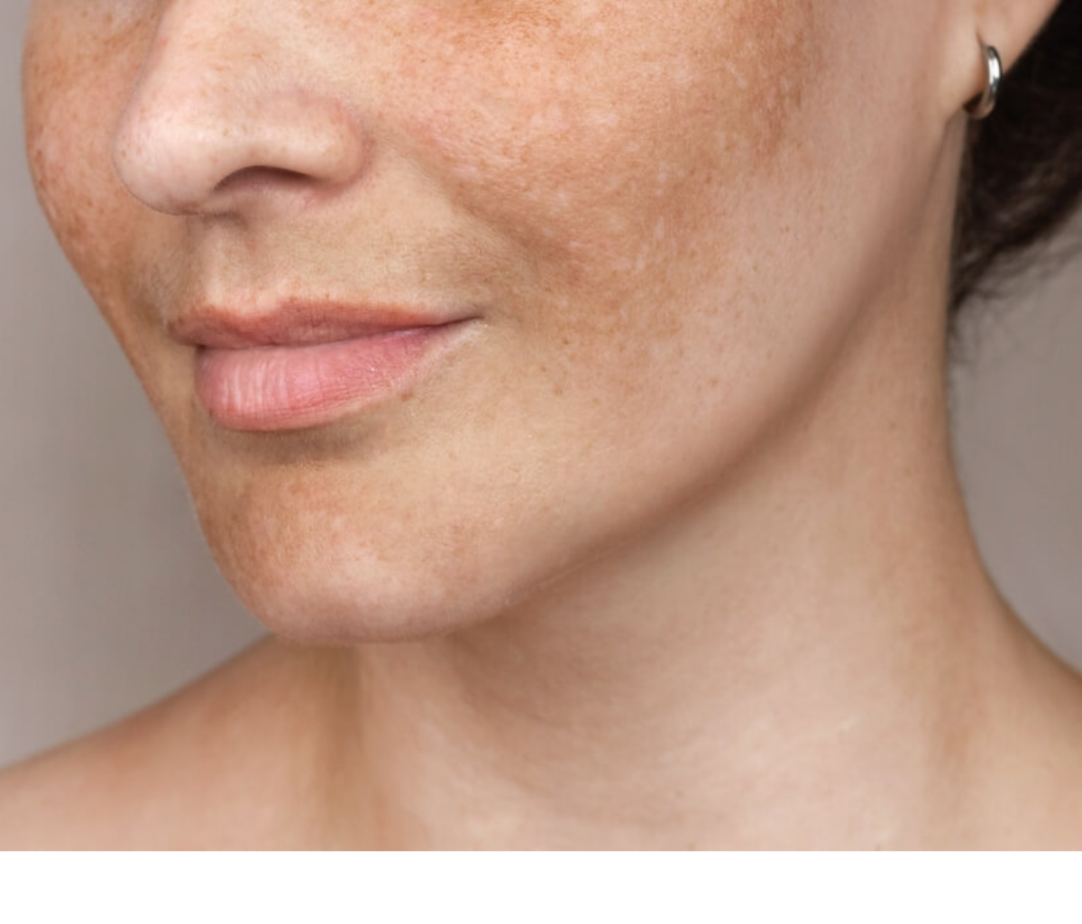 Wat is melasma en wat kun je eraan doen?